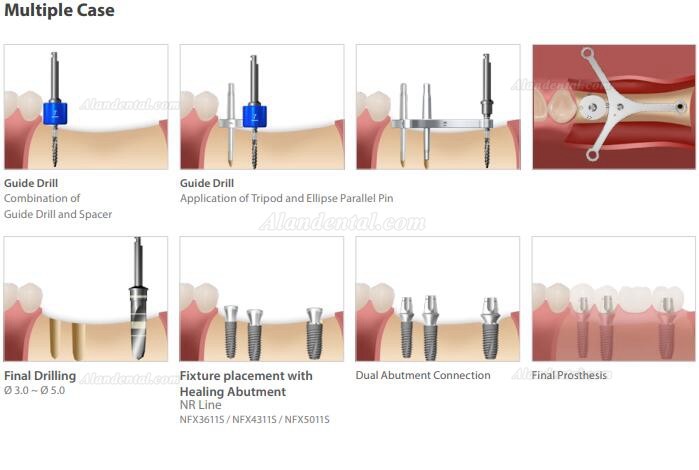 Dentium Implant Guide Kit (ISGK Kit) / Dental Instrument Kit